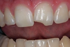 chipped teeth, Los angeles Chiropractor